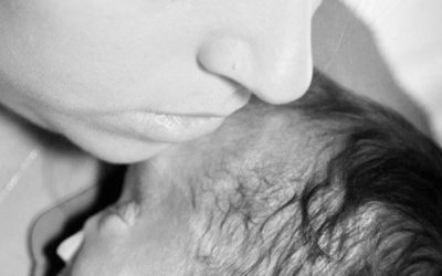 Sydney and Darren: Alobar Holoprosencephaly