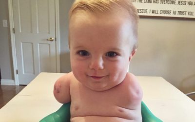 Casey: Limb Difference