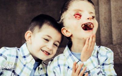 Lacey: Tessier Cleft