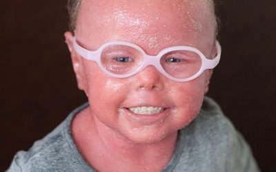 Courtney: Harlequin Ichthyosis