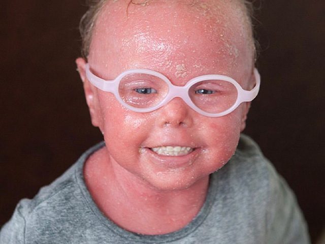 Courtney: Harlequin Ichthyosis