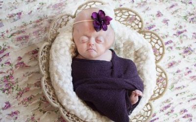 Amanda: Pfeiffer Syndrome