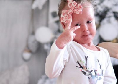 what “H.I.” means to us! A baby born with very a rare skin condition.