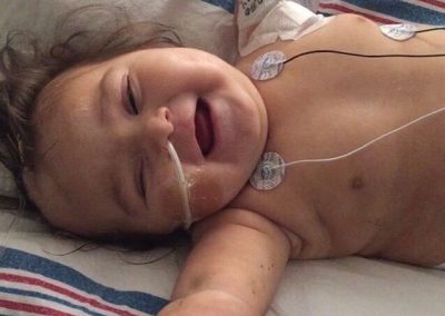 Microcephaly, GBS Meningitis, severe brain damage, hydrocephalus, hypertension and seizure disorder