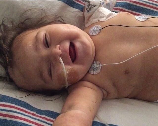 Microcephaly, GBS Meningitis, severe brain damage, hydrocephalus, hypertension and seizure disorder