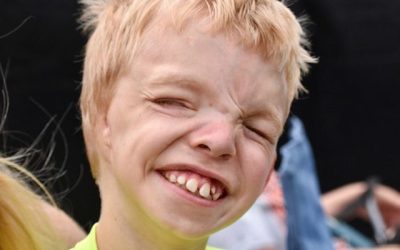 Regan: Goldenhar Syndrome