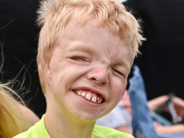 Regan: Goldenhar Syndrome